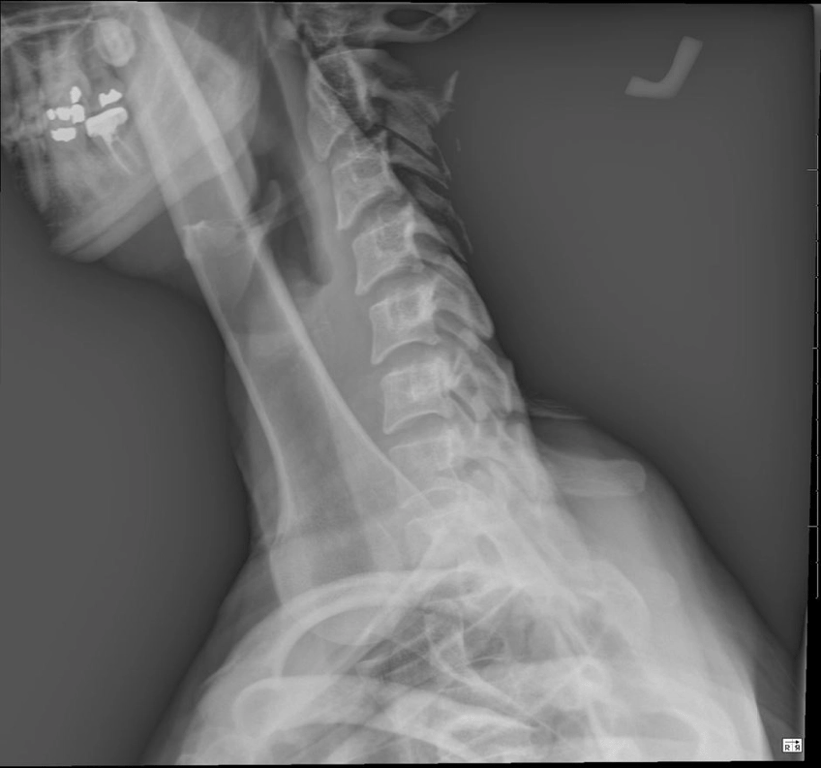 Over exposure artifact | Radiology Case | Radiopaedia.org