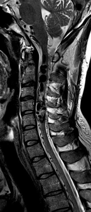 A close-up of an x-ray of a spine AI-generated content may be incorrect.