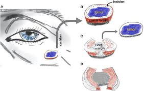 Figure 1. The principle of muffin technique micrographic surgery. The tumor is resected with a margin of healthy skin (A). The excised specimen is then incised 1–2 mm from the edge of the tissue block to form the lateral margins and ≅1 mm over the floor to form the deep margins (B). The central portion containing the tumor, the “muffin” itself, is removed (C)and the specimen is flattened to bring the lateral and deep margins, the “muffin paper,” into the same plane and color-coded for orientation (D). The histological sections are cut after being formaldehyde fixed and paraffin embedded in a horizontal direction starting from the bottom of the specimen. Of note, larger soft tumors can be curetted before excision, as is often practiced in mohs micrographic surgery. See also Supplementary Video 1.