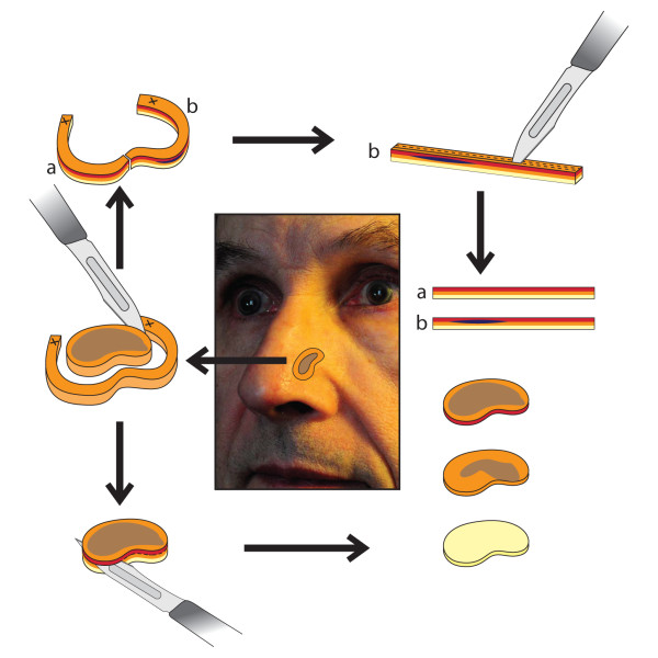 Micrographic surgery according to the Tuebingen cake technique. The base and the margin of the tumor are assessed separately