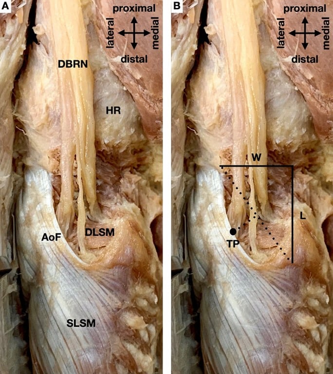 Proximal margin of the superficial layer of the supinator muscle