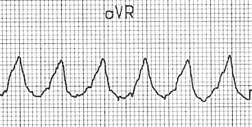 ECG image: LITFL ECG Library (litfl.com)