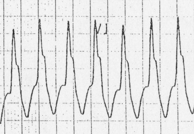 ECG image: LITFL ECG Library (litfl.com)