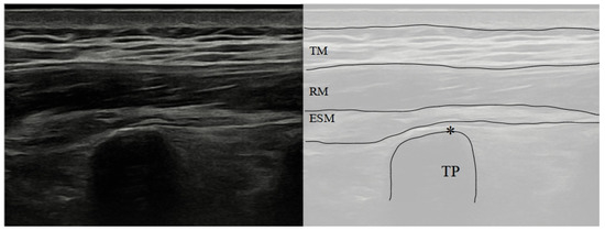 TM: Trapezius Muscle; RM: Rhomboid Muscle; ESM: erector spinae group muscle; TP: transverse process; *: target.