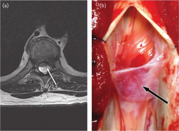 (a) Fig. 65.4 Arachnoid web. (A) Axial T 2 MRI image of the thoracic spine revealing anterior displacement and compression of the cord (arrow) caused by hydrostatic pressure built up above a spinal arachnoid web. (B) Operative appearances of an intradural arachnoid web (arrow) forming a diaphragm across the theca, dorsal and lateral to the cord. 
