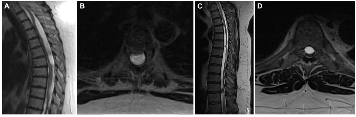 A-D, Preoperative T2 MRI demonstrating spinal intradural arachnoid cysts of differing morphologies in our series. A and B, Case 13 with a T1-7 dorsal arachnoid
cyst. C and D, Case 18 with a T3-8 ventral arachnoid cyst.