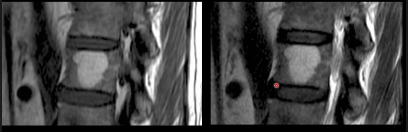 Haemangioma