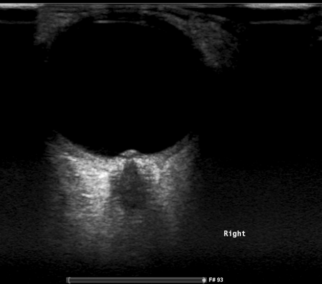 Gaillard F, Sharma R, Mahsoub M, et al. Papilloedema. Reference article, Radiopaedia.org (Accessed on 22 Mar 2026) https://doi.org/10.53347/rID-1841