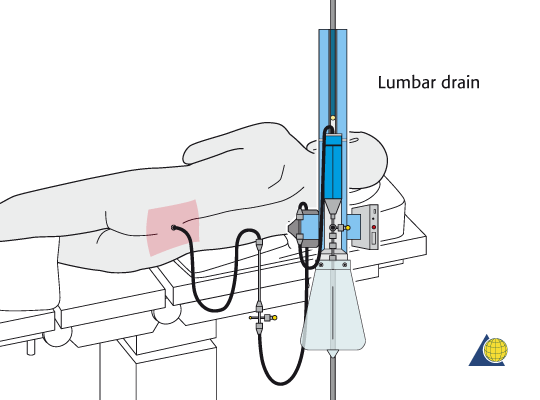 Spinal cord perfusion protocol (SCPP)