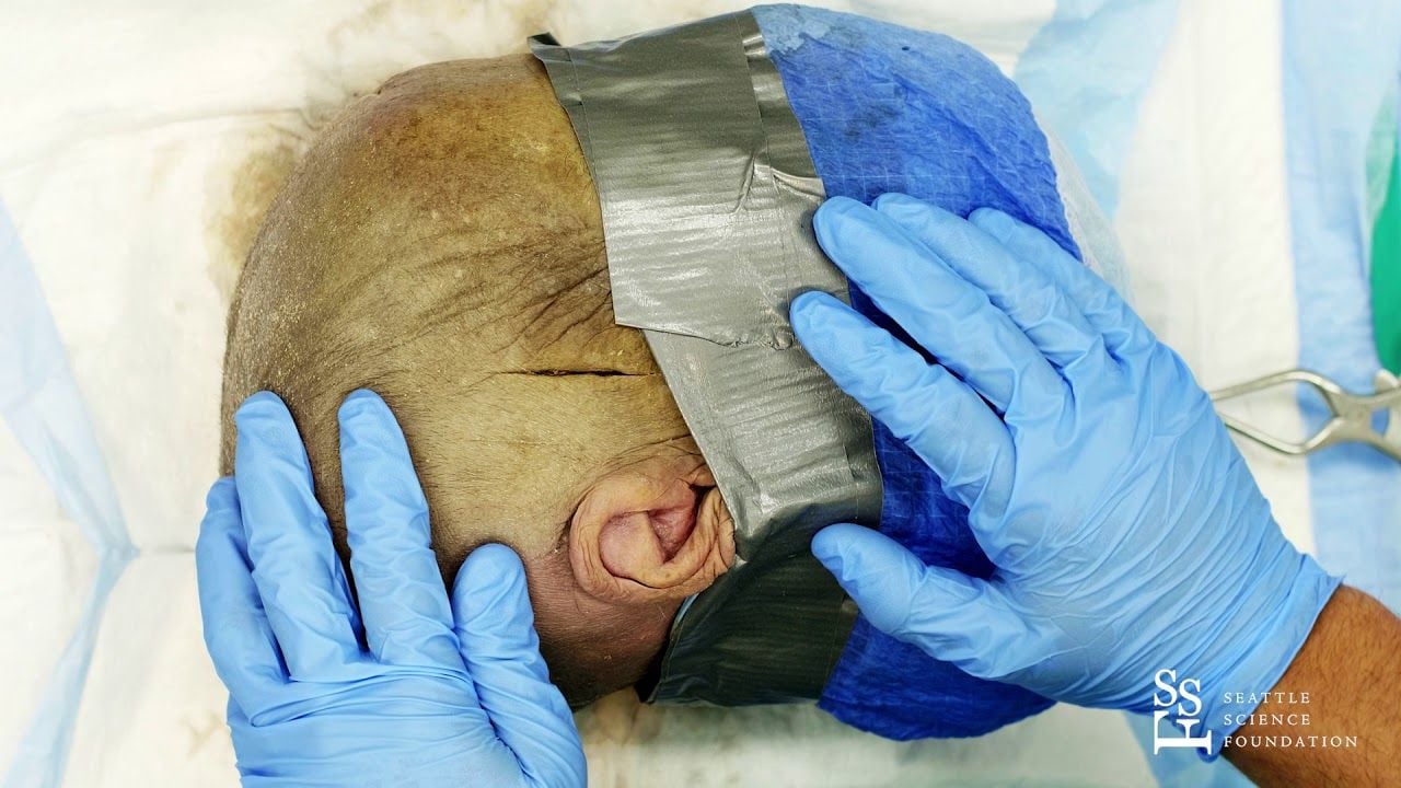 Emergency Burhol Craniatomy   Juan