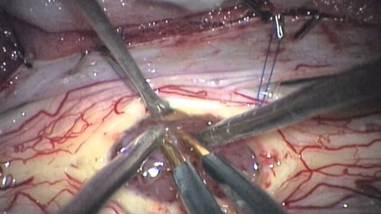 Microsurgical resection of intramedullary spinal cord ependymoma