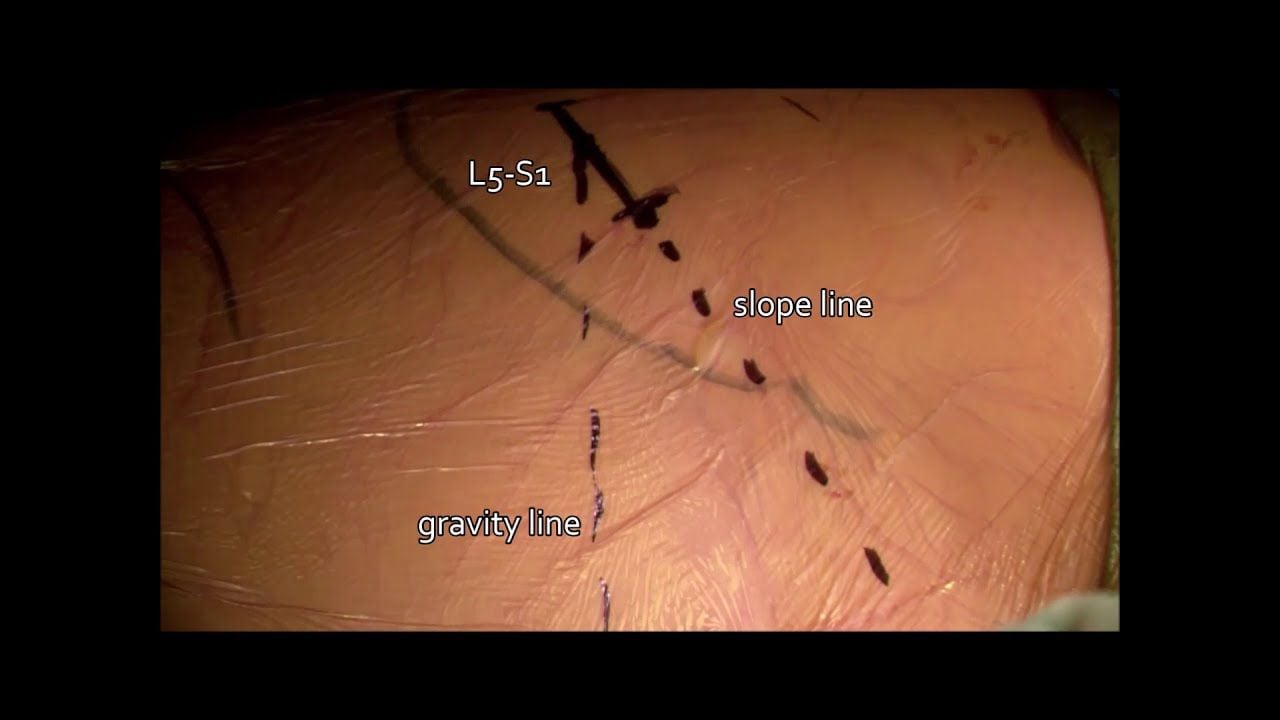 Minimally Invasive L5-S1 Oblique Lumbar Interbody Fusion (OLIF Surgical Technique)