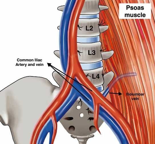 Iliolumbar vein: a challenge for the exposure of the L4-5 disc in the  anterior approach to the lumbar spine | European Spine Journal