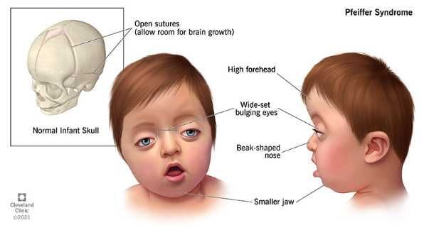 Pfeiffer Syndrome: Symptoms, Causes, Diagnosis, Treatment