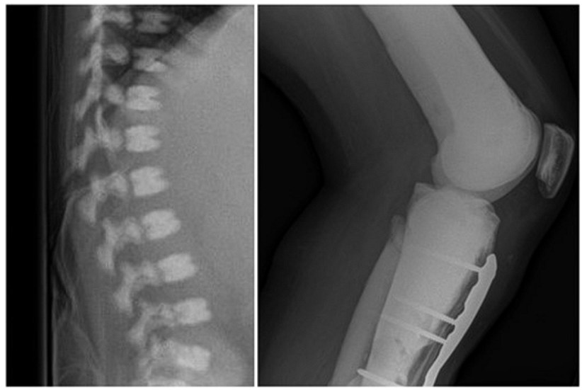 Left: Vertebral midbodies sandwiched between dense bands along superior and inferior endplates (“sandwich vertebrae”). 
Right: Bone-within-bone appearance.