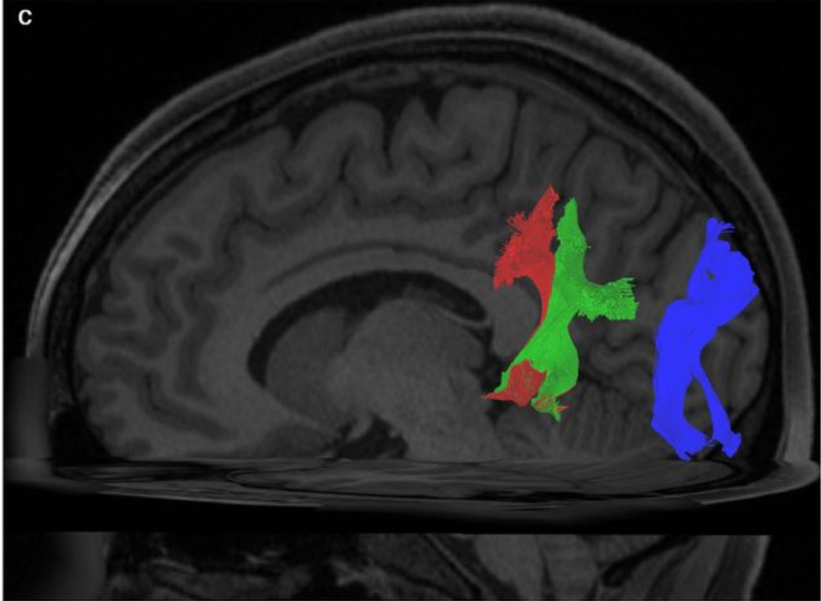 Sagittal view of the left hemisphere of a single subject. Visible are the VAF and VOF. The VAF has been segregated manually, and separate colors have been assigned to to the vVAF (red) and dVAF (green). The VOF has been colored blue. Apparent is the anteroposterior spatial separation between the entire VAF and the VOF. 

