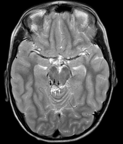 Chemical shift artefact of a quadrigeminal lipomas