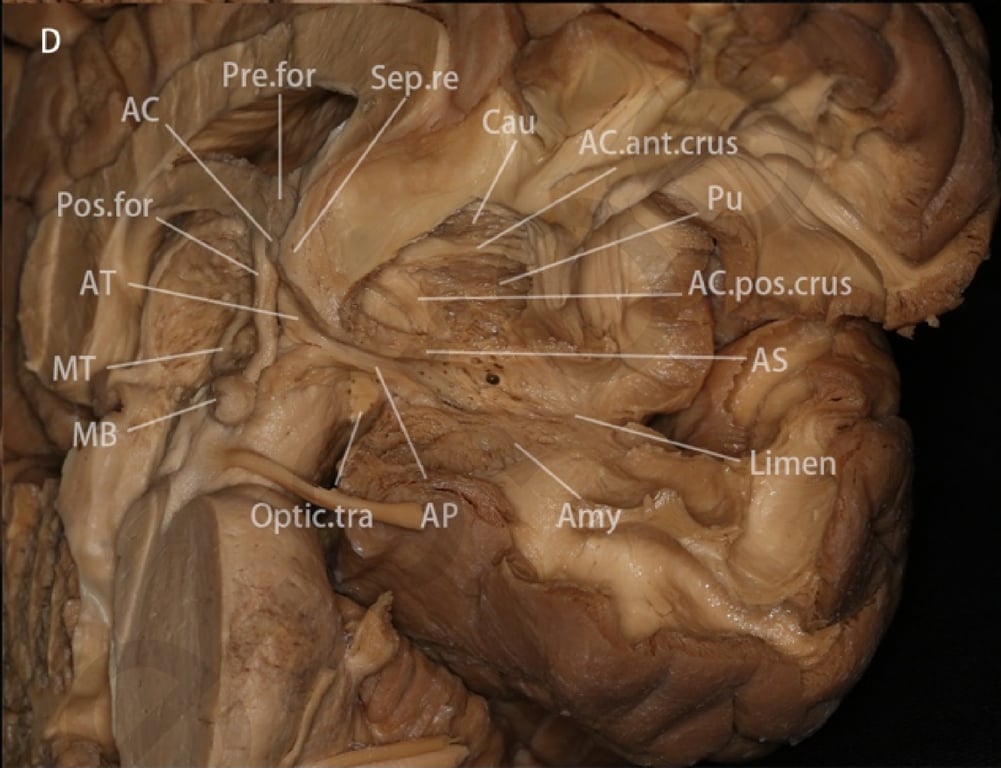 D: Anterior and medial views of the ansa peduncularis after the optic chiasm and part of the optic tract were removed. The amygdaloseptal and amygdalothalamic pathways fuse to form the ansa peduncularis, located superior to the optic tract, posterior and inferior to the anterior commissure and runs laterally to the amygdala and anterior temporal cortex.