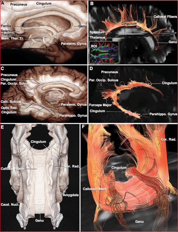 Calc, calcarine; Caud, caudate; Cor, corona; Mam, mammillo; Nucl, nucleus; Occip, occipital; Parahippo, parahippocampal; Paraterm, paraterminal; Par, parieto; Rad, radiata, radiations; ROI, region of interest; Thal, thalamic; Tr, tract.