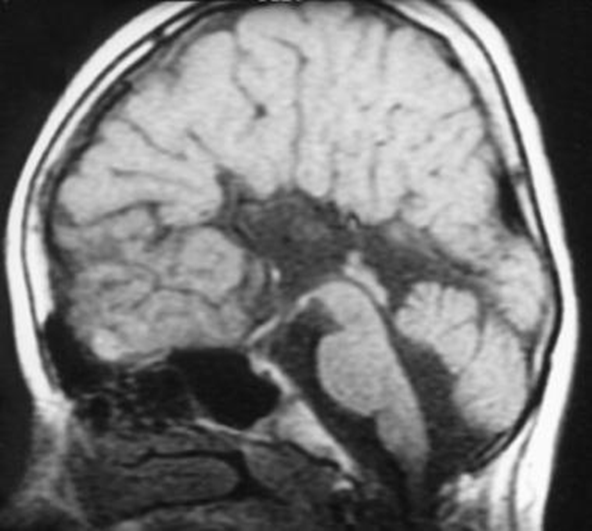 Sagittal T1-weighted MRI shows agenesis of the corpus callosum and a hypoplastic inferior vermis in a 13-year-old girl with thoracal scoliosis and Dandy-Walker variant.
4th ventricle is slightly enlarged, but the posterior fossa typically is normal in size.