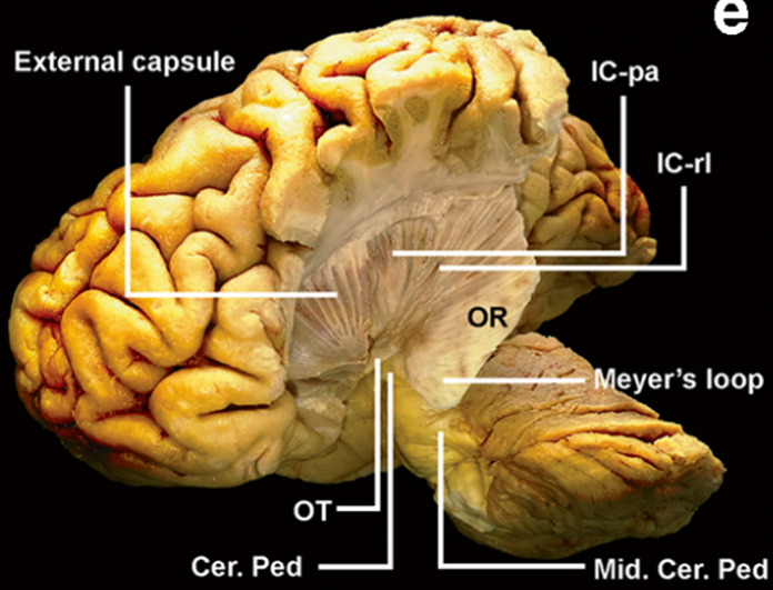 OR: optic radiation 
OT: optic tract 
IC-PA: internal capsule posterior arm 
IC-RL: internal capsule retrolenticular portion 
Cer Ped: cerebral peduncle 
Mid Cer Ped: middle cerebellar peduncle