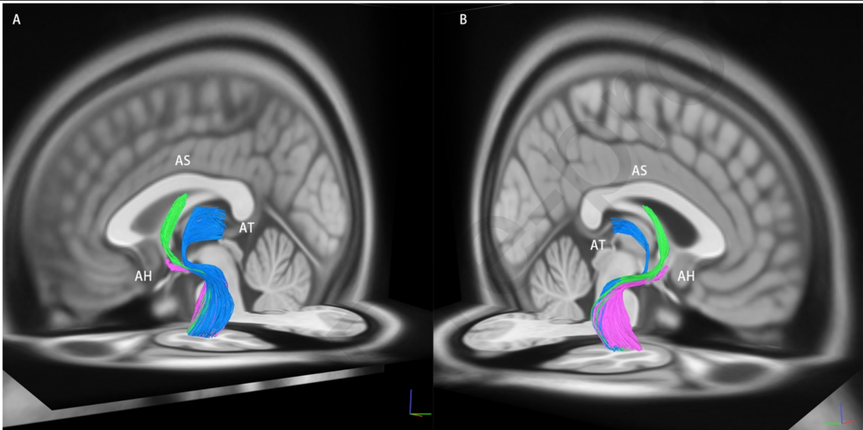 Left (A) and right (B) view. - AS: amygdaloseptal fibres - AT: Amygdalothalamic fibres - AH :Amydalohypothalamic fibres