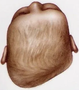 Severe plagiocephaly