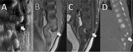 (A) sagittal ultrasound, 
(B) sagittal T2-weighted magnetic resonance imaging (MRI), 
(C) sagittal T1-weighted MRI, 
(D) sagittal reconstruction of a noncontrast computed tomography scan. 
