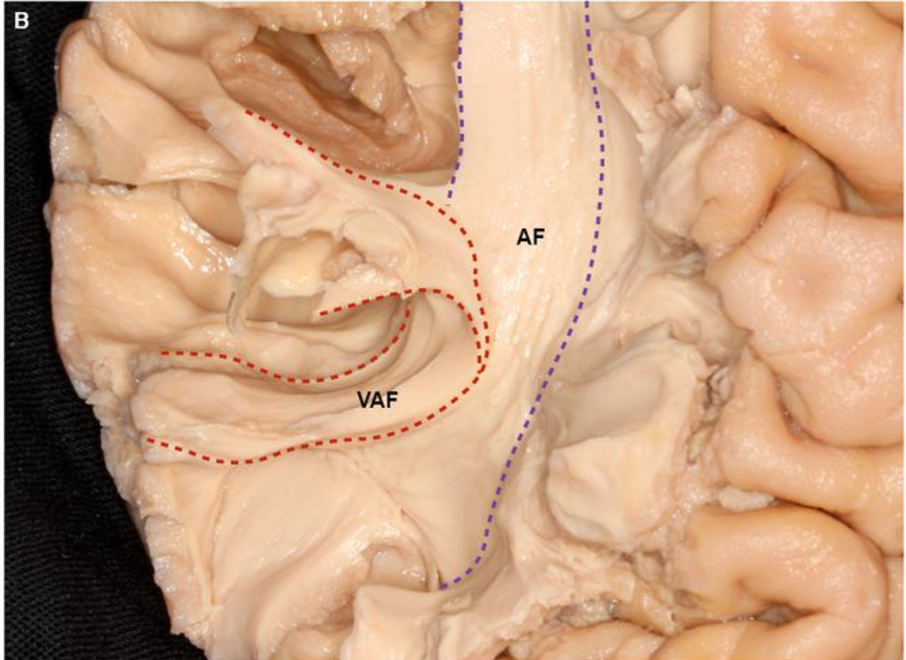 A magnified view of a dissected VAF, with its demarcation from the AF proper marked out. The VAF is bounded by red-dashed lines, and the AF-proper is bounded by purple-dashed lines. 