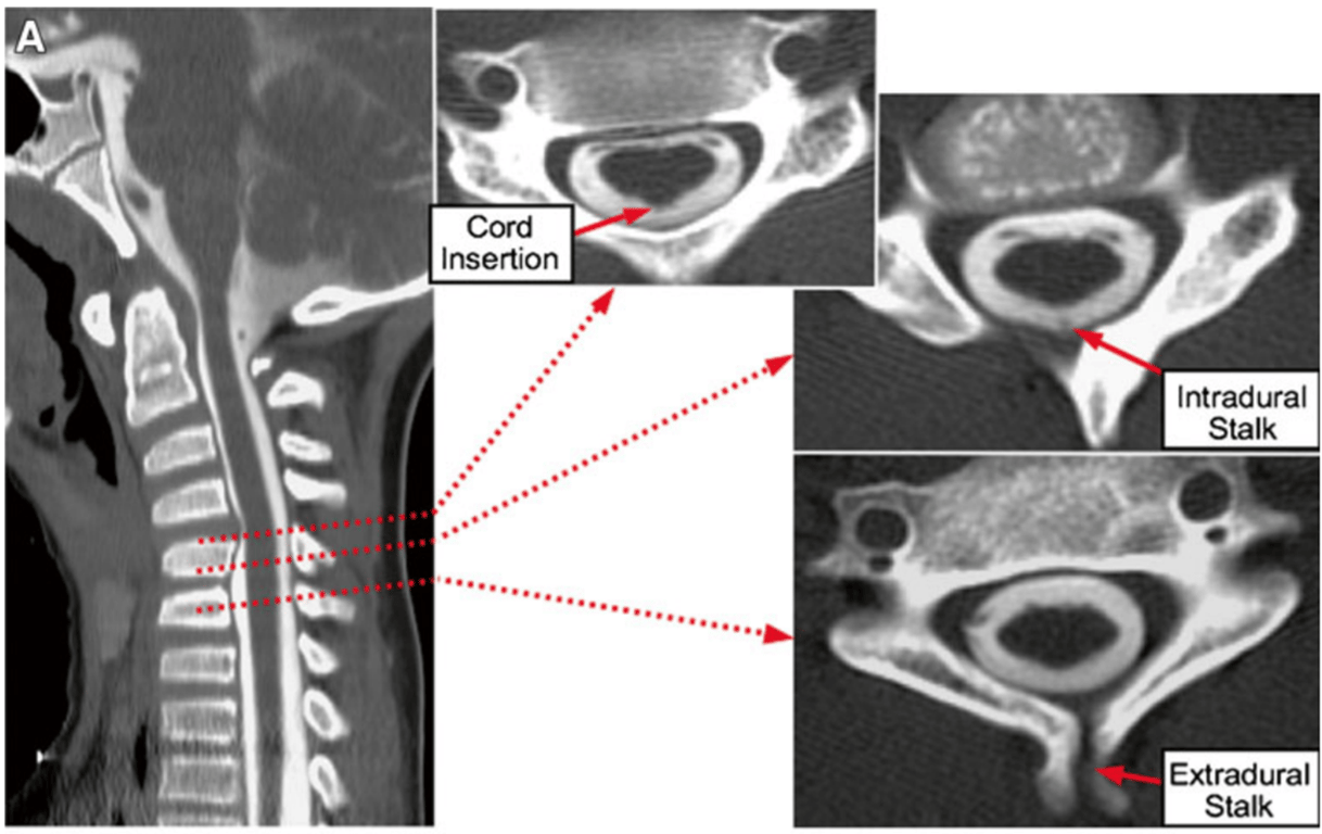 A CT Myelogram shows extradural LDM stalk penetrating soft tissue at C6 (lower axial image). The intradural stalk traverses the dorsal CSF space at C5 (middle axial image), and joins the dorsal cord surface opposite the C4/C5 interspace, where the cord has a dorsal nubbin at point of insertion