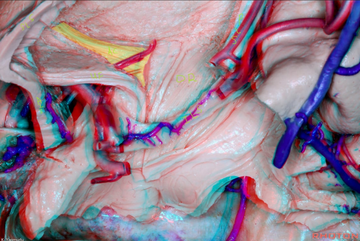 AC: anterior commissure
OR: optic radiation
UF: uncinate fasciculus
AIS, SIS, PLS, ILS: anterior, superior, posterior, inferior limiting sulcus