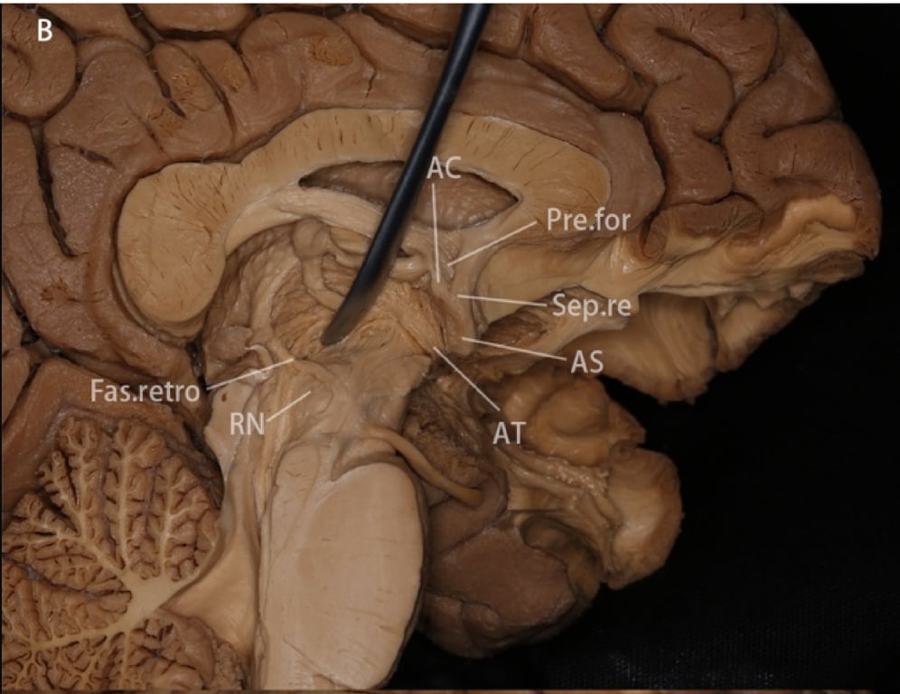 B: The postcommissural fornix was displaced posteriorly, and the optic chiasm was removed to expose the ansa peduncularis. The amygdalothalamic pathway connects the medial thalamic nucleus with the amygdala and anterior temporal cortex, running inferior to the body of the anterior commissure and lateral to the postcommissural fornix, converging with the amygdaloseptal pathway at the anterior hypothalamus. The amygdalohypothalamic pathways were removed with the chiasm and hypothalamus.