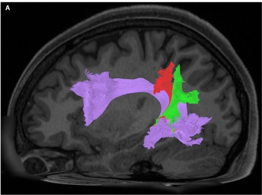 A sagittal view of the left hemisphere of a single subject. This image demonstrates the relationship of the vVAF (red) and dVAF (green) to the underlying AF (purple).