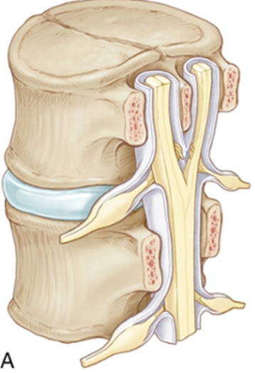 1 (Diastematomyelia) ONE=BONE