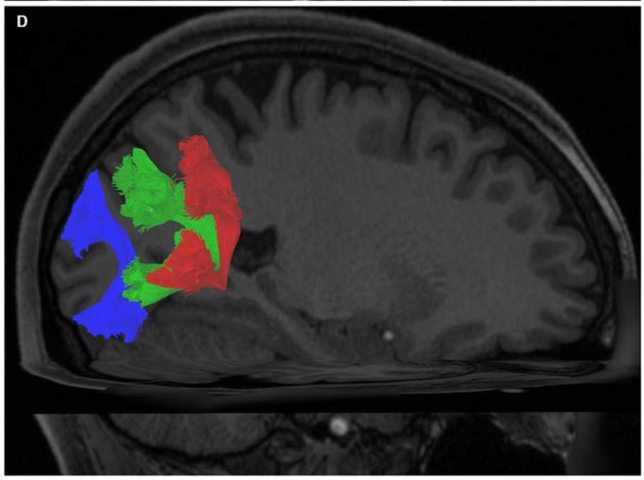 Sagittal view of the right hemisphere of a single subject. Visible are the VAF and VOF. The VAF has been segregated manually, and separate colors have been assigned to the vVAF (red) and dVAF (green). The VOF has been colored blue. Apparent is the anteroposterior spatial separation between the entire VAF and the VOF.