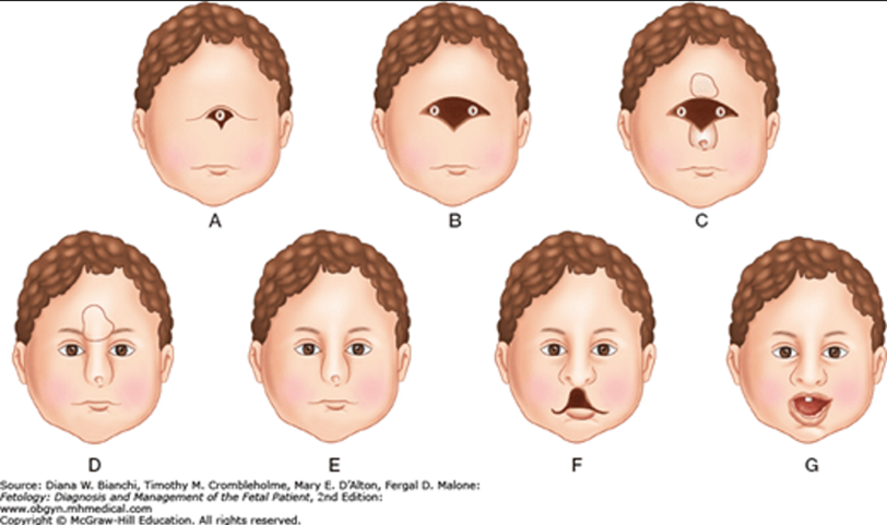 A and B demonstrate cyclopia.
C shows cyclopia with a proboscis.
D shows ethmocephaly with a proboscis.
E demonstrates cebocephaly with a single nostril.
F shows mild holoprosencephaly with a midline cleft lip.
G is the mildest form of holoprosencephaly with a single central incisor