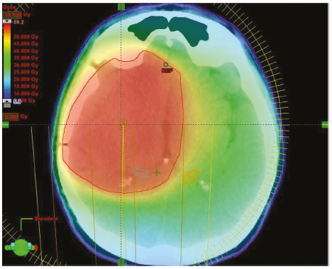 Same glioma but using IMRT