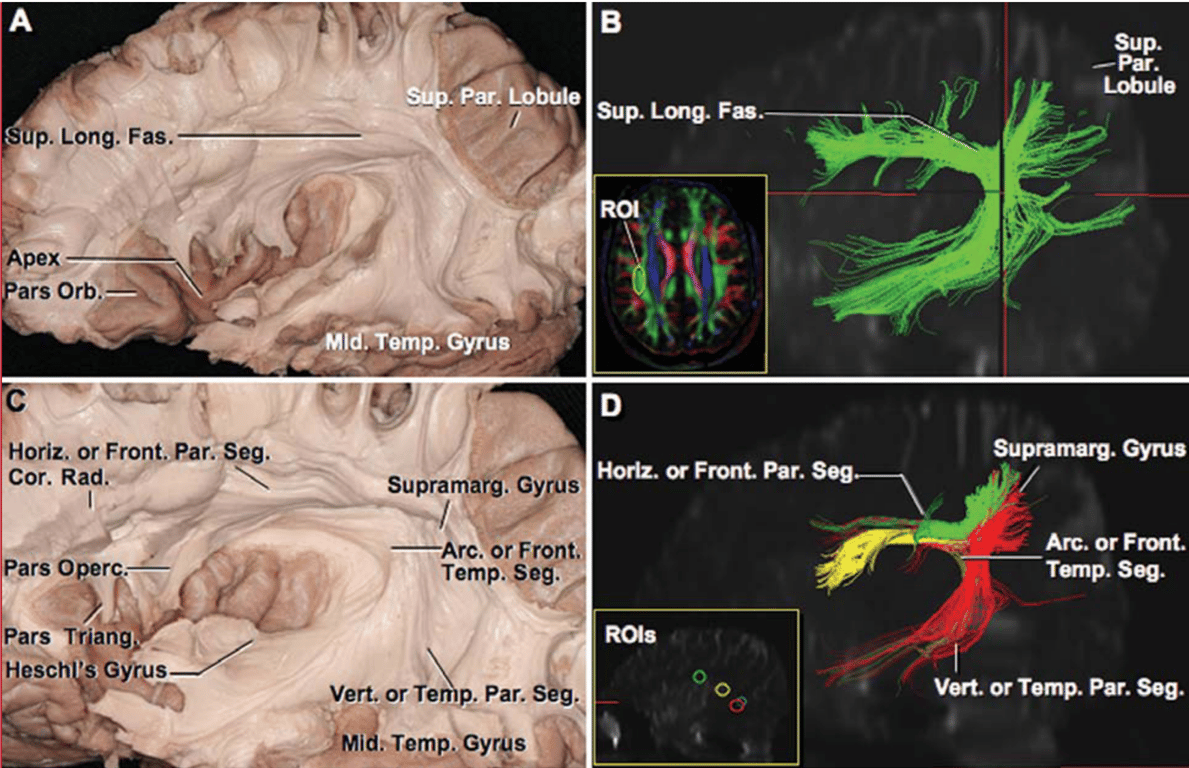 A, removal of the cortical gray matter and adjacent superficial short fibers of the frontal, temporal, and parietal opercula, the middle frontal, superior temporal, and middle temporal gyri, and the inferior parietal lobule exposes the superior longitudinal fasciculus arching around the outer edges of the insula. The superior parietal lobule and the pars orbicularis of the inferior frontal gyrus are intact. Long fibers are observed descending from the frontal opercula, precentral and postcentral gyri, inferior parietal lobule, and transverse superior and middle temporal gyri. 