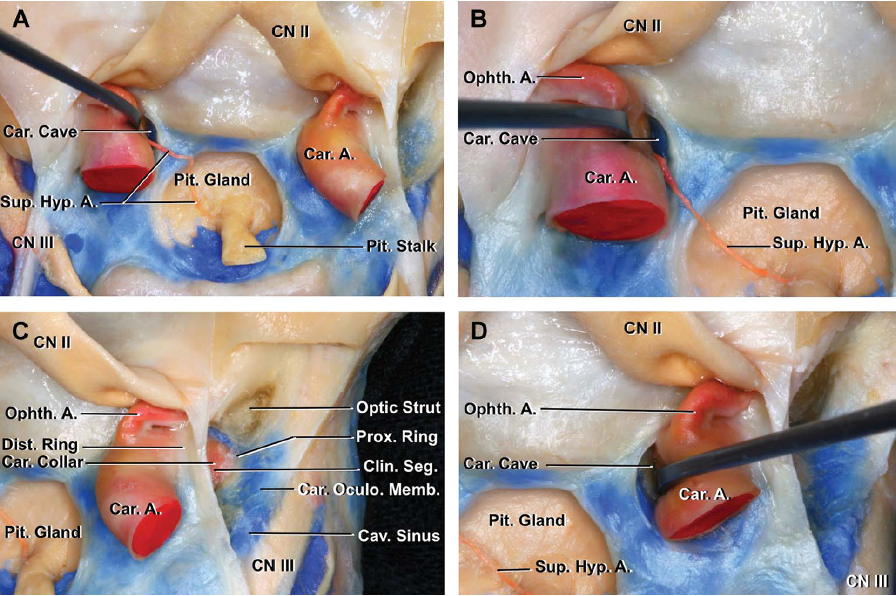 Right anterior clinoid is being cut off.