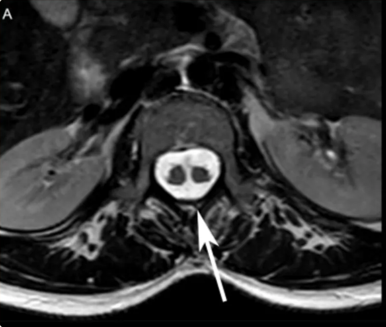 T2-weighted image, axial plane, level of L2, shows a single dural sac containing both hemicords with appearance of the chondro-osseous ligament central in anteroposterior orientation.