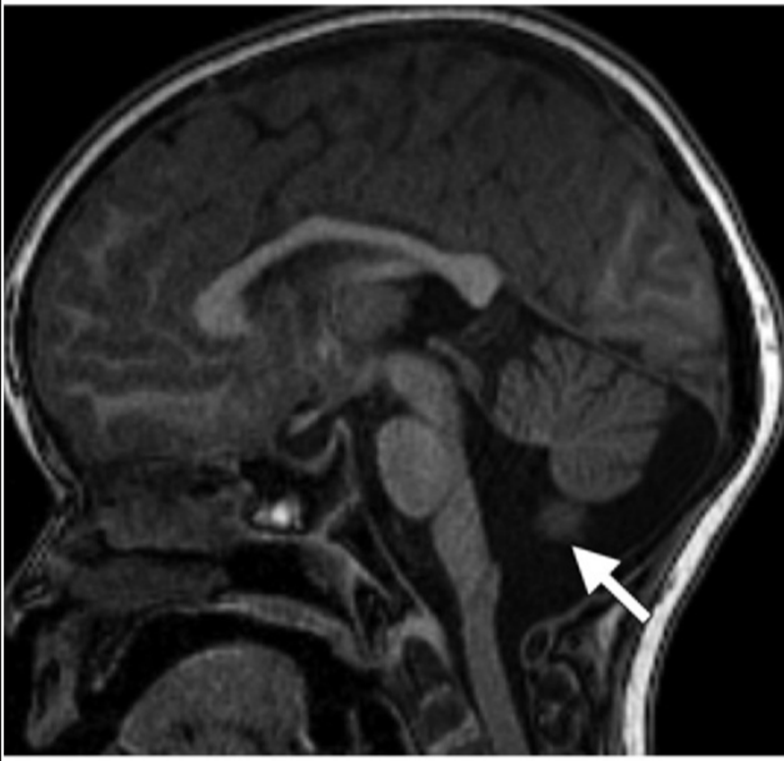 partial absence of the inferior vermis (arrow) and apparent but not true enlargement of the fourth ventricle