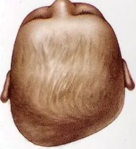 Moderate plagiocephaly