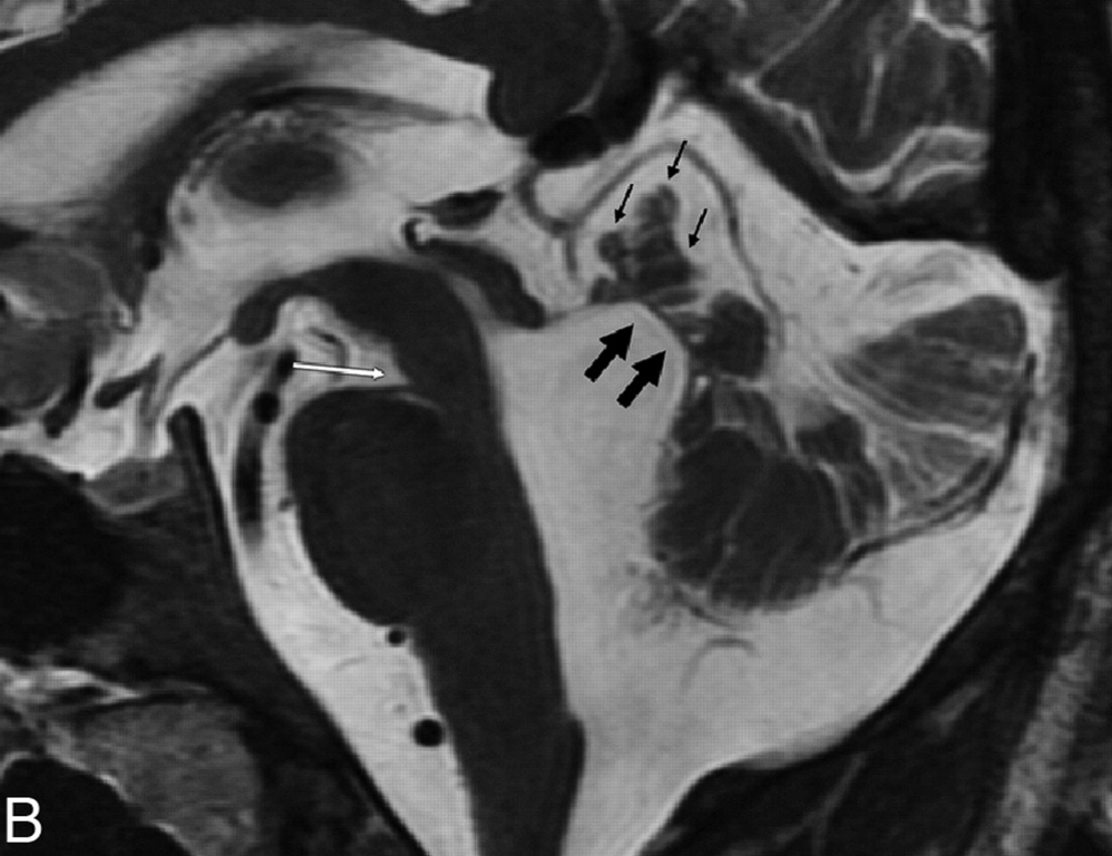 a severe vermian hypoplasia-dysplasia (thin black arrows), and distortion and enlargement of the fourth ventricle with rostral shifting of the fastigium (thick black arrows), enlargement of the PF, a deepened IF (white arrow), and a narrow pontomesencephalic isthmus.

