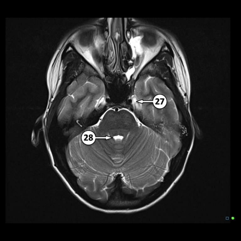 Normal Superior cerebellar peduncle (28)