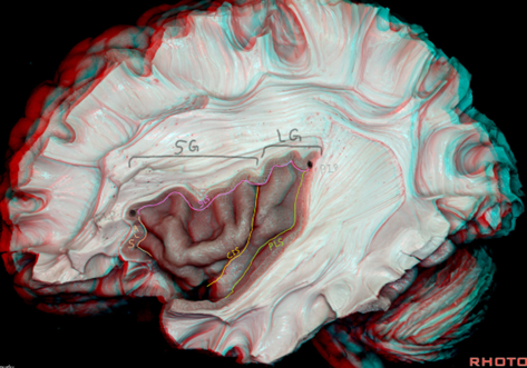 SG: Short gyrus
LG: Long Gyrus
PIP: posterior insular point: Atrium
AIP: Anterior insular point: Frontal horn
ALS: Anterior Limiting sulcus
PLS: Posterior limiting sulcus
SLS: Superior limiting sulcus
CIS: Central insular sulcus
All are circular limiting sulcus