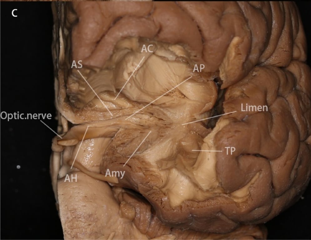 C: Anterior view of the ansa peduncularis. The gyrus rectus, orbital gyrus, lateral and media olfactory stria, olfactory tubercle, anterior perforated substances, part of the nucleus amygdala and temporal pole were removed to expose the ansa peduncularis, which extends laterally superior to the optic tract and inferior to the anterior commissure, and reaches the amygdala and anterior temporal cortex. 