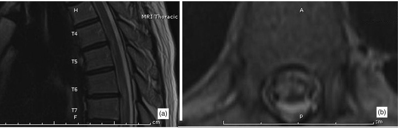 Sagital (a) and axial (b) T2 sequence MRIs showing hyper-intense lesions in the distribution of the Anterior spinal artery in a 63-year-old man clinically diagnosed with spinal cord infarction due to FCE. The lesions are characteristically opposite to disc protrusions at T4–5 and T6–7 thoracic levels.