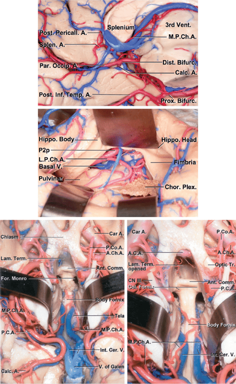 The top sagittal photo in the current figure illustrates the anatomic relationship of the MPChA to the third ventricle. The middle image demonstrates the more proximal anatomy of the LPChA through the left temporal horn (viewing from inside the temporal horn out), whereas the bottom photo shows the MPChA anatomy relative to the third ventricle from an inferior point of view