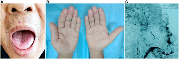 (A) Telangiectasias on the tongue, lip and peri-oral region
(B) palmer aspects of the hands
(C) post-embolization image showing contrast blush in the nasal, upper lip and hard palate areas.