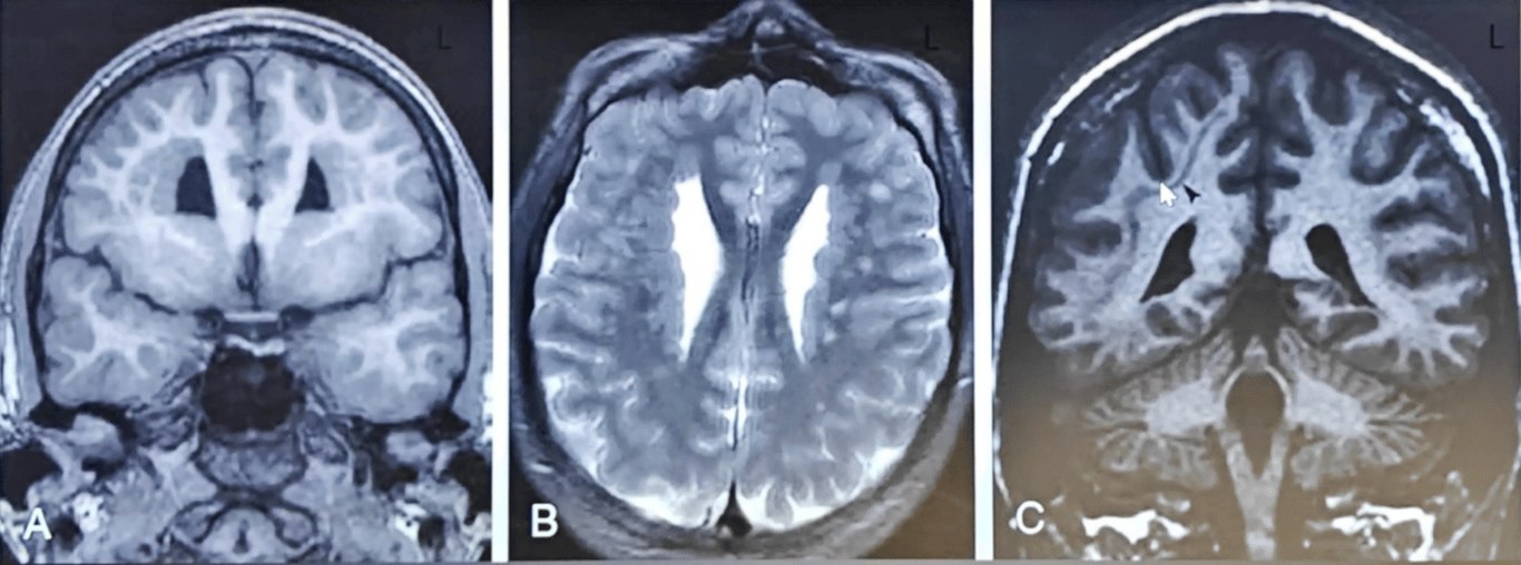 Abnormal neuronal migration causing heterotopias (presence of grey matter in abnormal sites). 
A, B: Coronal T1 and axial T2 showing extensive bilateral subependymal nodular gray matter heterotopia
C: Coronal T1 showing band heteretopia in right cerebral hemisphere